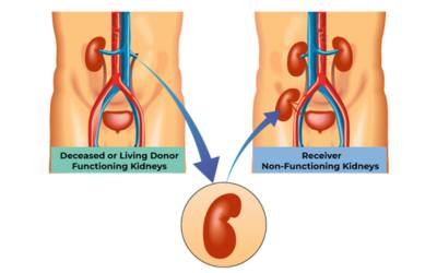 Kidney Transplant